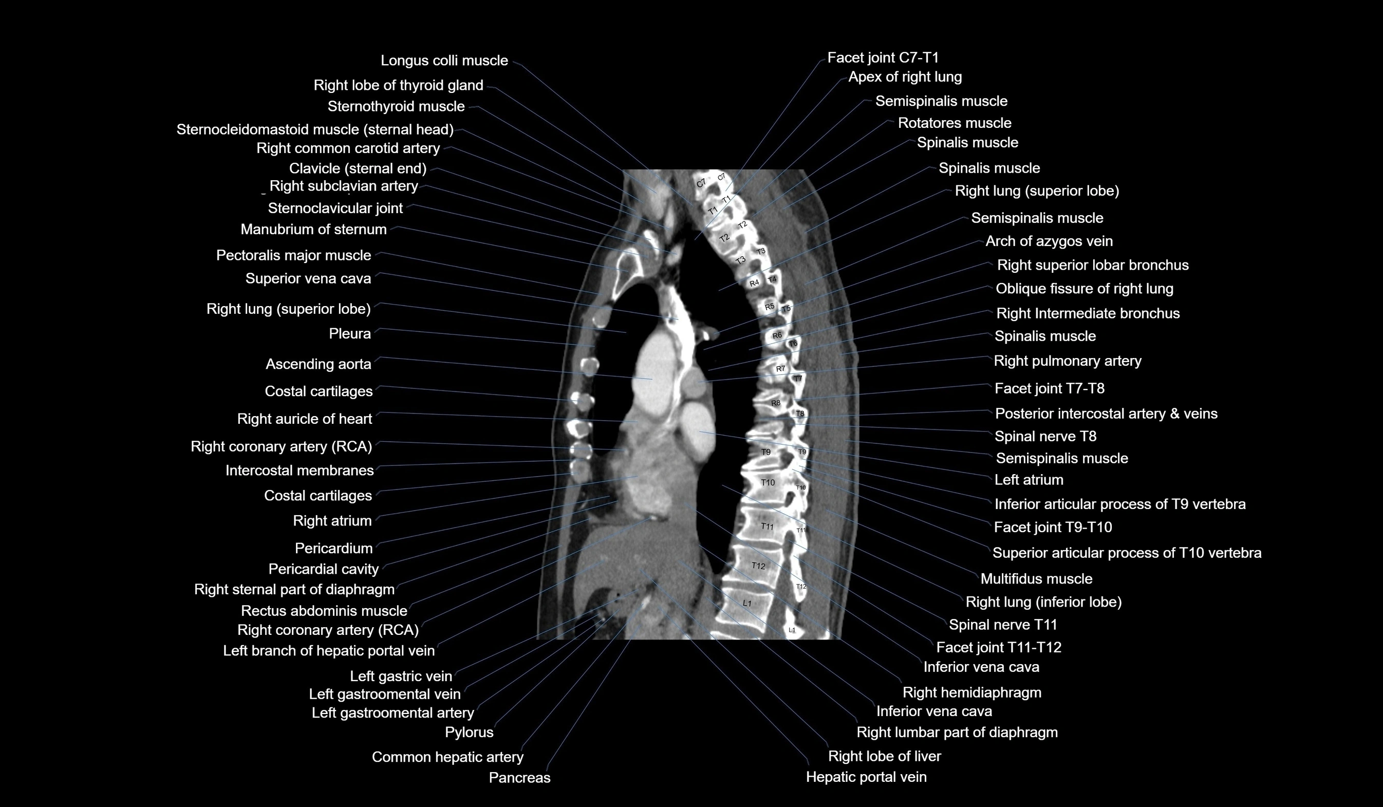 CT chest (thorax) labelled sagittal cross sectional anatomy radiology image-00067.webp